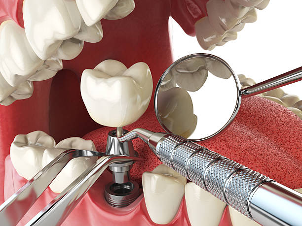 Best Emergency Treatment for Dental Infections or Abscesses in Spring Valley, AZ